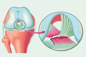 ACL Reconstruction