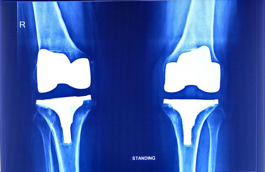 after-knee-replacement-surgery