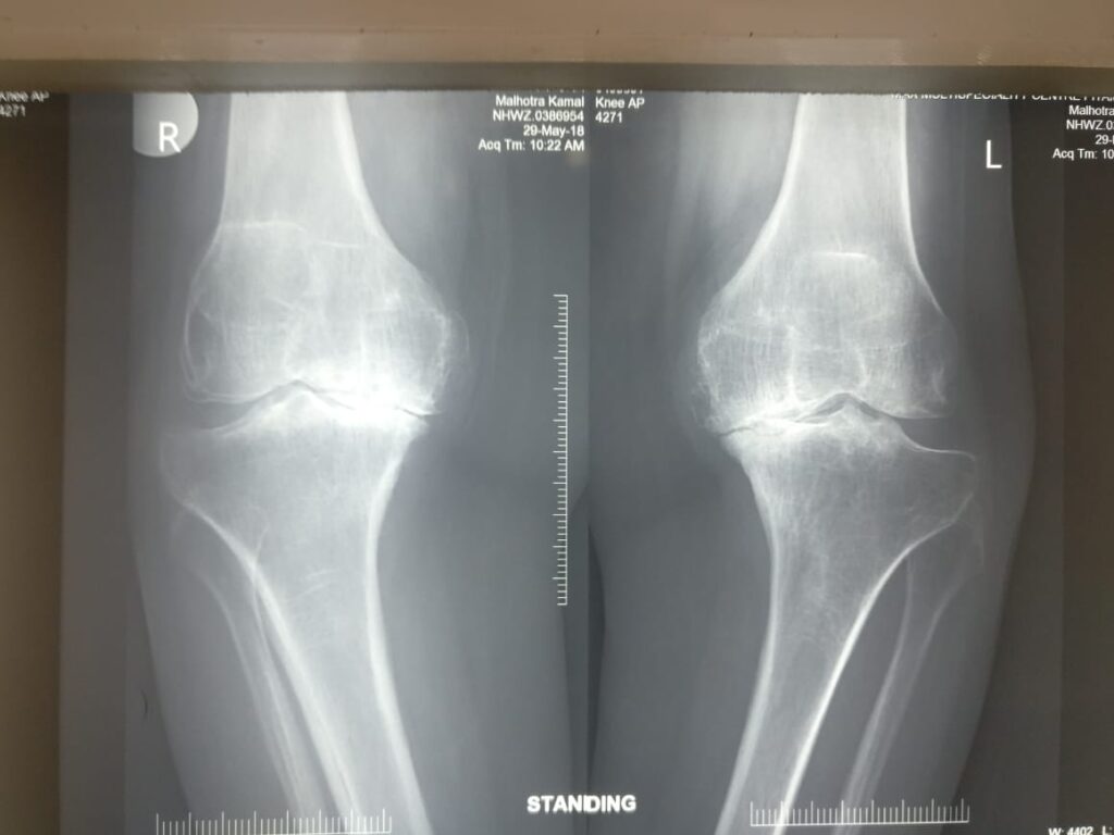 before-knee-replacement-surgery